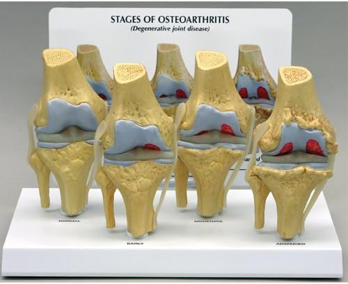 4-Stage Osteoarthritis Model
