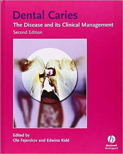 Dental Caries: The Disease and Its Clinical Management Dental Caries: The Disease and Its Clinical Management