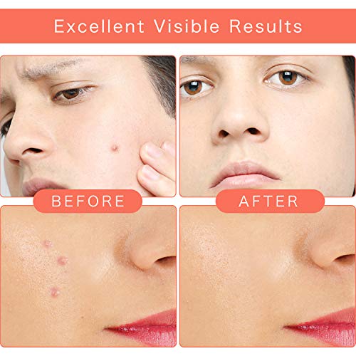 Liberex Acne Pimple Healing Patch Invisible Face Zit Stickers