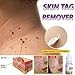 Meflying Strength Skin Tag Remover Foot Treatment Mole Skin Tag Body Warts Remover Skin Care Tools