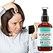 Dry Scalp Treatment, For Psoriasis, Eczema, Itchy And Flaky Scalp - StratumRX Psoriasis Treatment Serum And Itchy Scalp Treatment - Big 4 OZ Size!