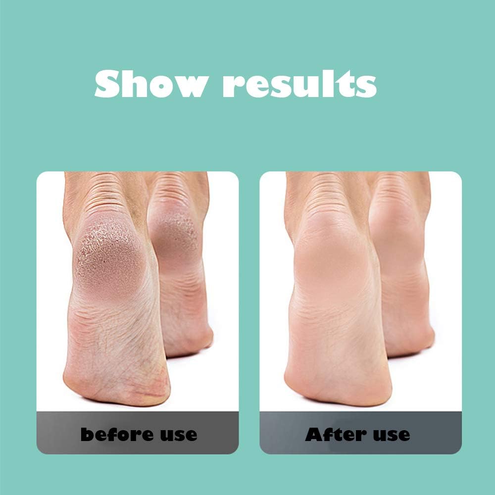 Portable Electric Foot Grinder，New Model USB Electronic Foot File Pedicure Tools，Dual Speed Callus Remover - Foot Pedicle Polisher Trimmer - Foot Care Tool for Hard Cracked Dry Skin: Home & Kitchen