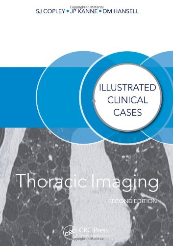 Thoracic Imaging: Illustrated Clinical Cases, Second Edition, by Sue Copley, David M. Hansell, Jeffrey P. Kanne