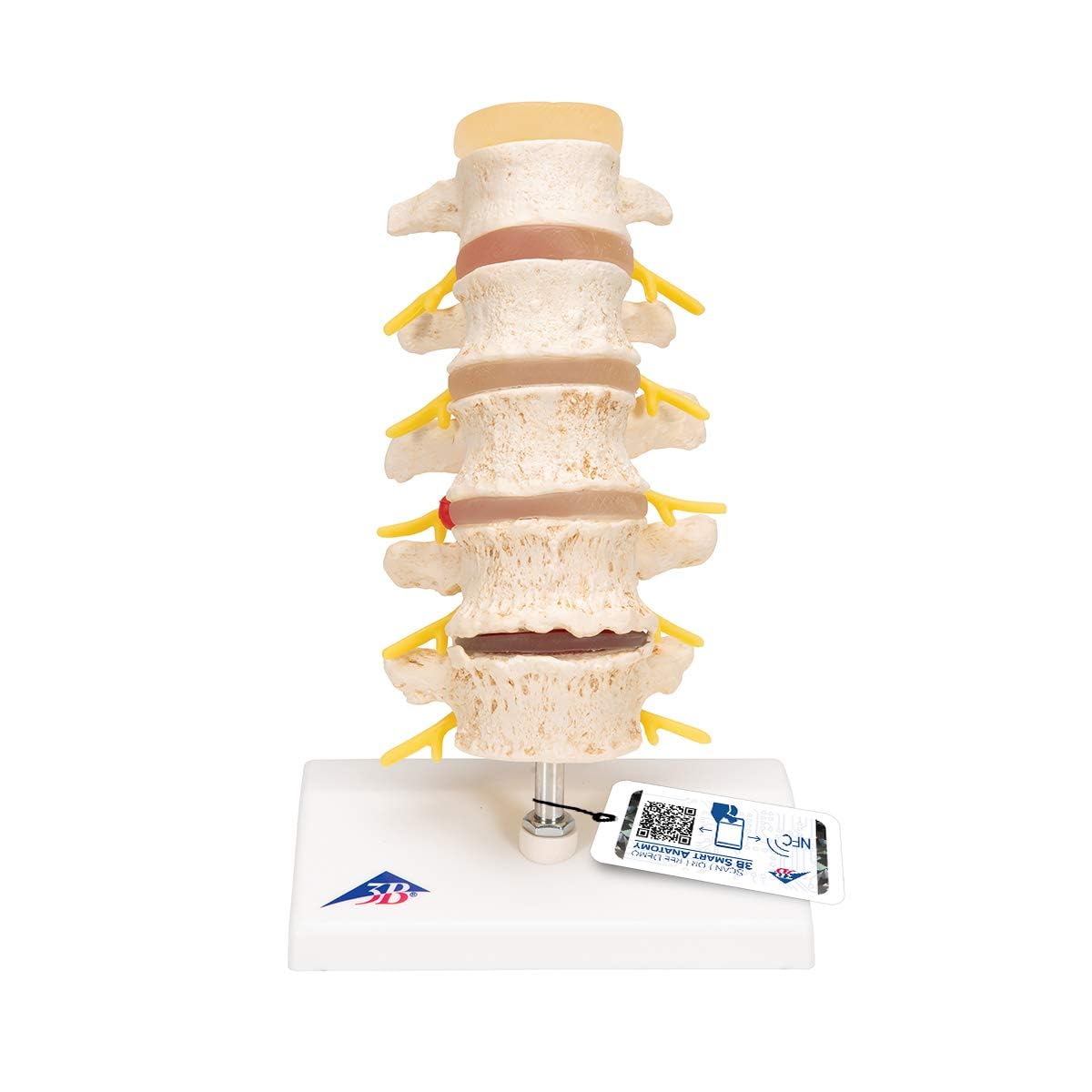 3B Scientific Stages of Disc prolapse and Vertebral Degeneration + free anatomy software - 3B Smart Anatomy A795