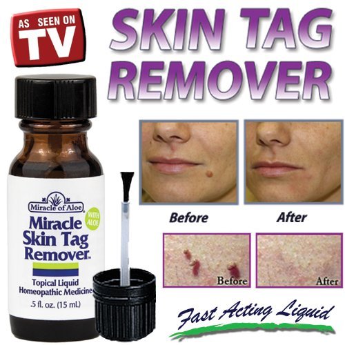 Miracle of Aloe Miracle Skin Tag Remover Homeopathic Skin Tag Medicine 0.5 Fl Oz Clinically Proven an All Natural Skin Tag Removal Solution Odorless That Helps Gently Remove Skin Tags in the Privacy of Your Home. Removes Tags From Legs, Armpits, Arms, Sho