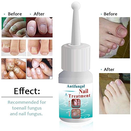 Fungus Stop,Nail Fungus Treatment,Anti fungal Nail Solution,Nail Care