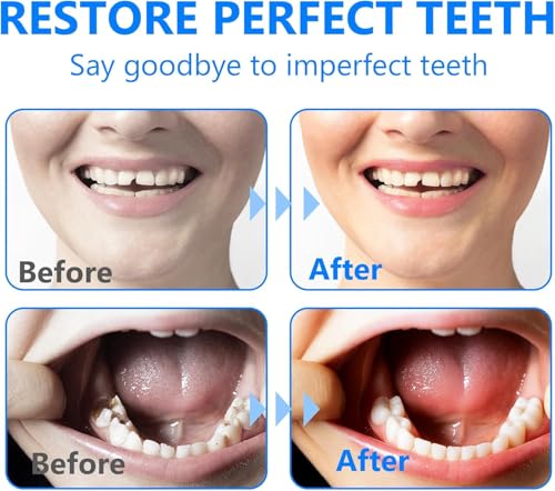 Tooth Filling Repair Kit, Temporary Tooth Repair Kit for Missing and Broken Teeth, with 4 Precision Tools, Natural Shade Emergency Smile Fix for Gaps and Chipped Molars