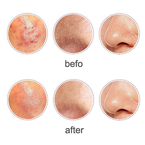 VOBAGA Blackhead Remover Pimple Comedone Extractor Tool Curved Acne Removal Kit,Treatment for Blemish,Whitehead Popping,Fat Particles,Zit popper with Silver Metal Case (Tweezers Kit 5pcs)