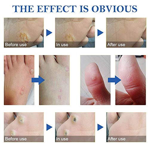 Corn Remover,Foot Corn Remover Pads, Corn Callus Remover Cushions,Corn Plaster with Hole,Corn Remover Pads for Foot Corn Removal Reduces Pain,24 Pads - Thumbnail 5