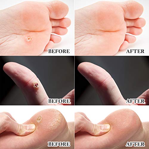 Wart Remover,Corn Remover,Foot Corn Remover Pads,Plantar Wart Removal