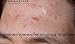 Aria Starr Anti Acne Treatment Serum & Pores Minimizer - BEST For Face, Stubborn Acne, Blackheads & Blemishes -1fl oz