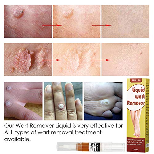Wart Remover, Plantar Wart Remover, Wart Removal, Corn Remover, Wart Removal Pen with Natural Ingredients, Penetrates and Remove Plantar Warts, Corns, Callus, Stops Wart Regrowth, 5mlX2 - Thumbnail 5