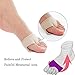 JAPAN SOLUTIONS Metatarsal Pads Cushions Sleeve Ball of Foot Pain Relief Gel Pad Sleeves for Forefoot Support, Arthritis, Tendonitis, Fracture, Diabetic L
