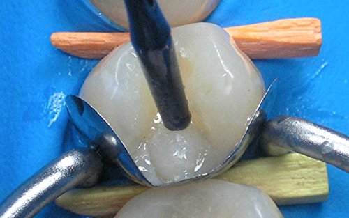 50 of Dental Sectional Contoured Matrices Matrix + 200 Wooden Wedges - Thumbnail 4