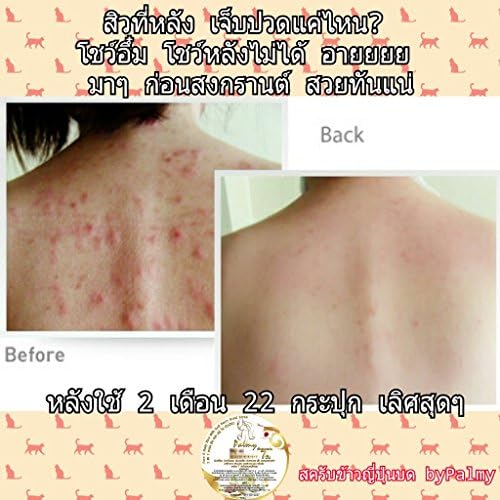 5 Days Butt & Back Acne Clearing Scrub 185g. (Dead Sea & Japanese Rice Organic Scrub)