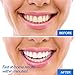Teeth Whitening Strips Teeth Bleaching System - Professional At Home Teeth Whitening Strips - 28 Count - Instant Results!
