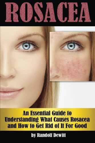 Rosacea: An Essential Guide to Understanding What Causes Rosacea and How to Get Rid of It For Good