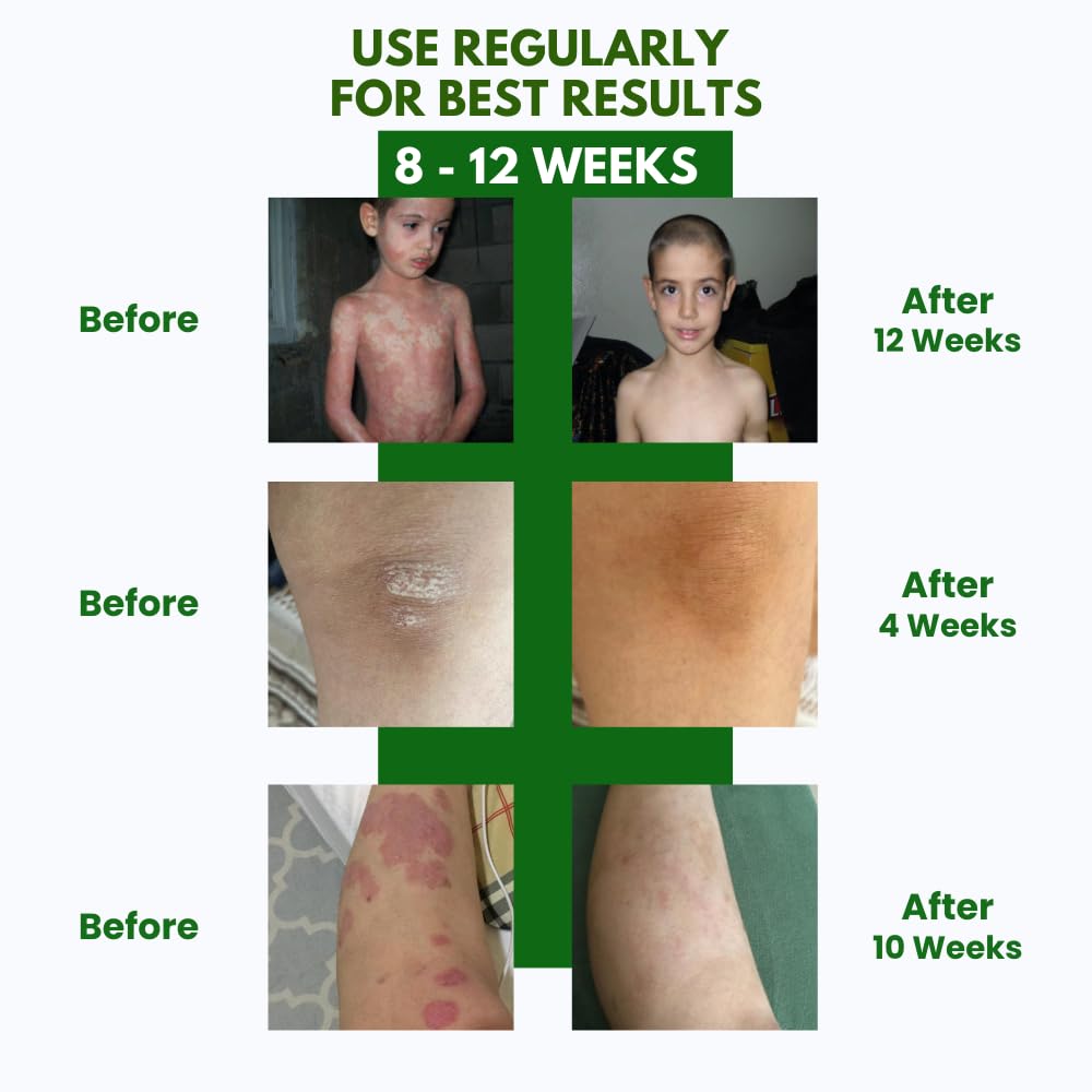 PSODEX Psoriasis Cream – 3.4fl oz Topical Psoriasis Treatment with Coal Tar, Salicylic Acid, Tea Tree Oil, Aloe Vera – All-Natural Ingredients – Soothing and Moisturizing Coal Tar Psoriasis Cream