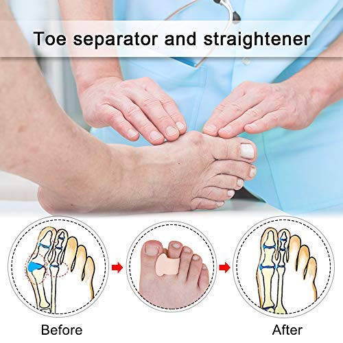 Skyfoot\'s Toe Separator for Bunion - Overlapping Toe Spreader Gel Toe Spacer Pack of 6 (Beige)