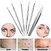 Professional Surgical Blackhead Remover Tools, 2018 Blemish and Splinter Acne Pimple Removal Kit, Come Done Extractor Tool for Whitehead, Pimples and Zit Popper Leather Case with Mirror, Pack of 6