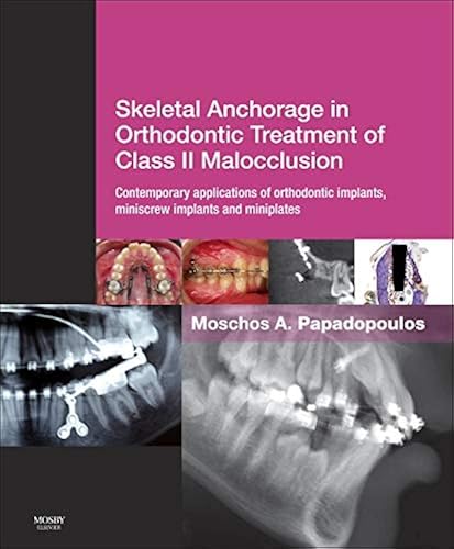 Download Skeletal Anchorage in Orthodontic Treatment of Class II Malocclusion: Contemporary applications of orthodontic implants, miniscrew implantsand mini plates PDF