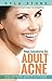 Real Solutions for Adult Acne: The Essential Guide to Clear Skin for Life