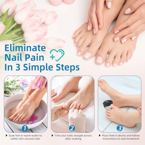 Nail Fungus Laser Device Upgrade, Anti-Fungal for Damaged and Discoloured