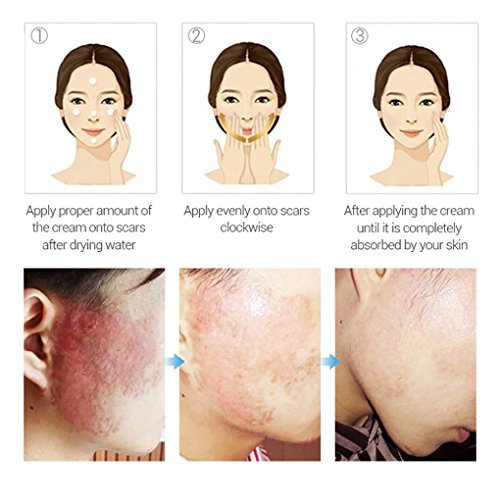 Hometom Scar Removal Gel Skin Repair Cream Acne Spot Treatment Reduces The Old & New Scars (Yellow) - Thumbnail 3