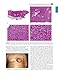 Cutaneous Soft Tissue Tumors
