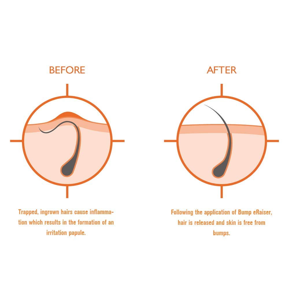 Amazon Com Bump Eraiser Concentrated Ingrown Hair Serum For