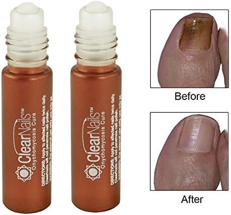 (Set of 2) Clear Nails Onychomycosis Fungus Cure Natural &amp; Organic by Fungal Free Nails