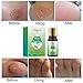 Wart Removal, Corn Callus Remover, Plantar Wart Remover, Foot Wart Remover, Common and Plantar Warts Treatmentthumb 3