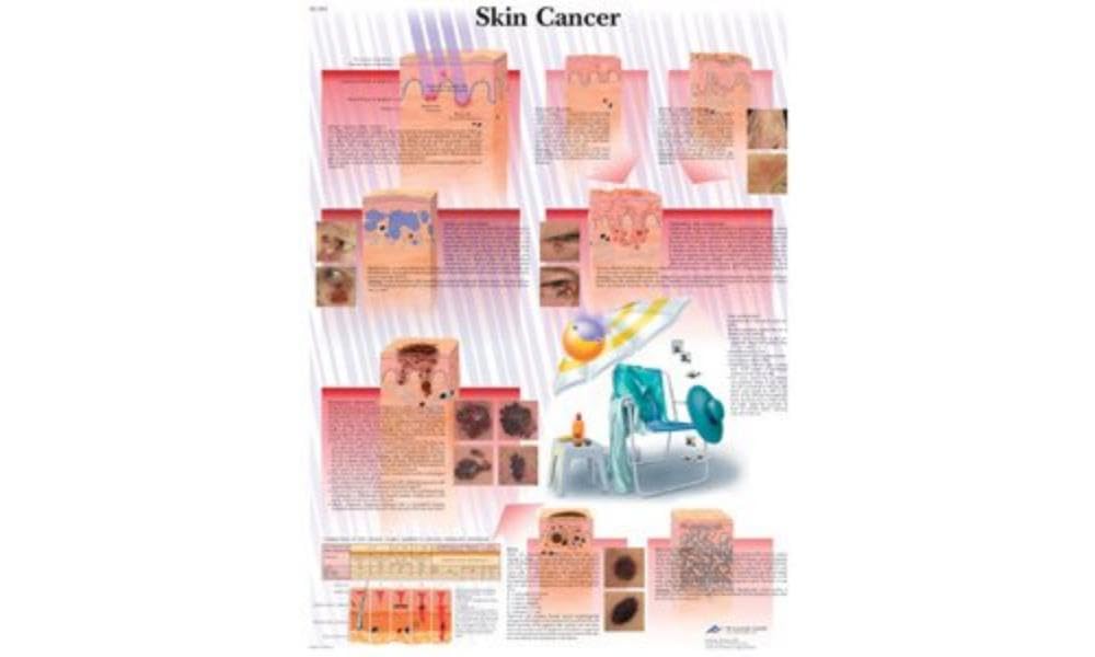 3B Scientific Human Anatomy - Skin Cancer Chart, Paper Version