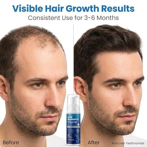 5% Minoxidil Foam for Men Women, 120ml 5% Minoxidil for Men Foam, Minoxidil for Women Hair Growth Suitable for Hair Thinning Receding Hairline and Hair Loss to Hair Regrowth Get Thicker Fuller Hair