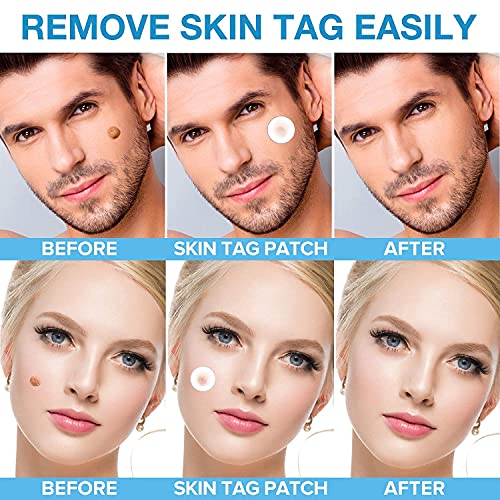 Skin Tag and Acne Remover Patches, Natural Ingredients, Advanced