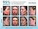 Neutralyze Moderate To Severe Acne Treatment Kit (30 Day)