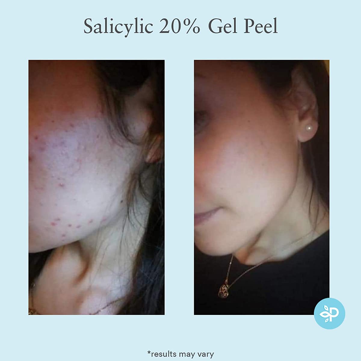 Salicylic 20% Gel Peel, Breakout and Pore Minimizer and Cleanser, Strength Level 2, 15-30 Full Facial Chemical Peels, 1 fl oz. e, 30 ml: Beauty