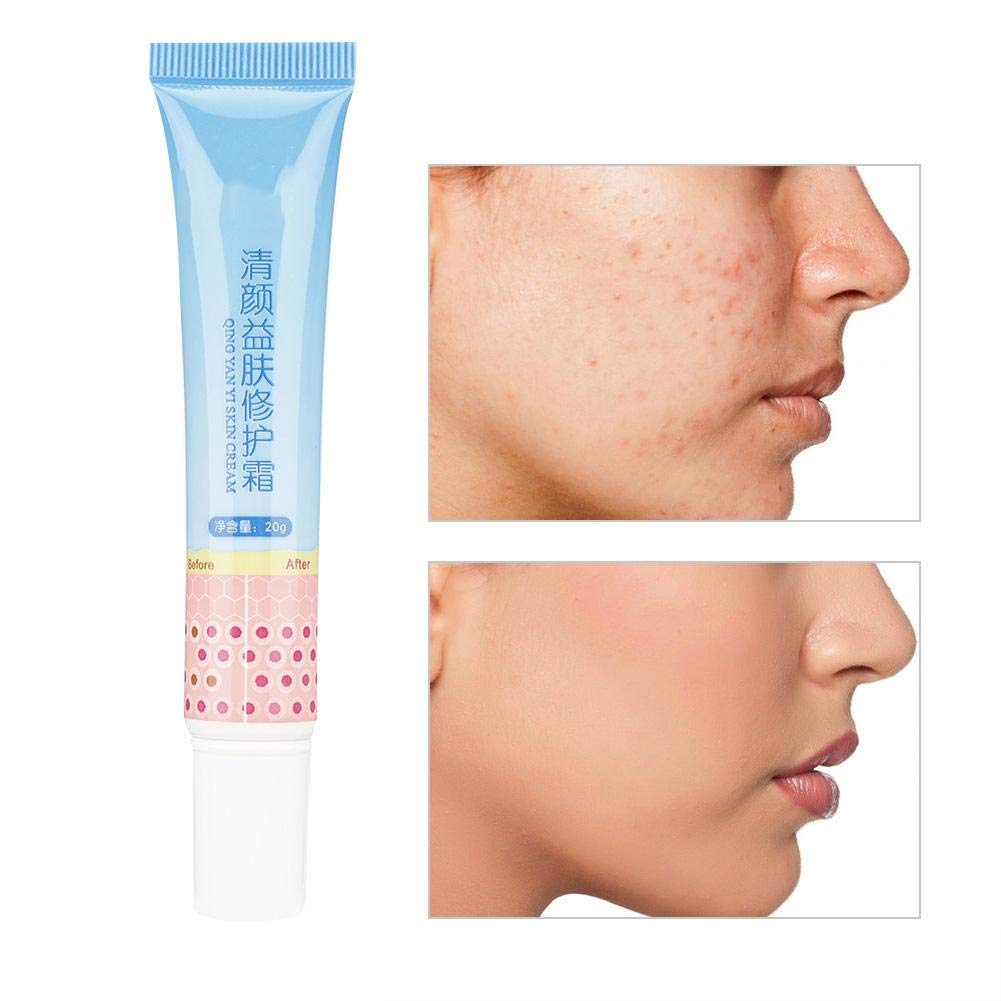 Amazon.com: Anti-Acne Cream, 20g Soothing Acne Cream Oil Control Face