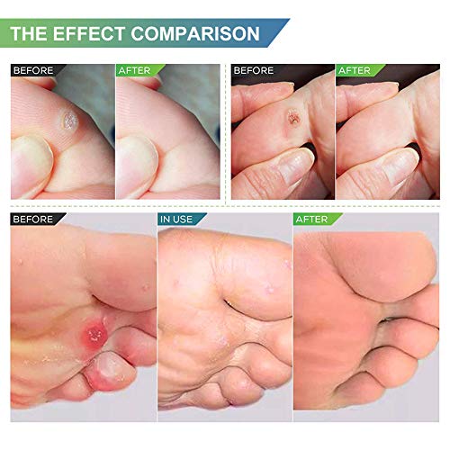 Wart Remover, Corn Remover Pads, Foot Corn Removal Plaster with Hole, Professional Removes Common and Plantar Warts, Callus, Stops Wart Regrowth 24Pcs
