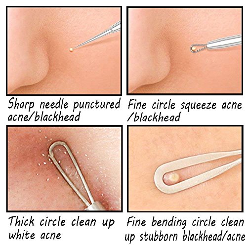 image for ACNE TREATMENT: SCAR REMOVAL & HOW TO GET RID OF PIMPLES WITH HERBAL M