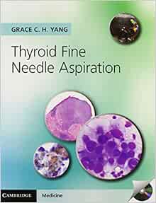 Thyroid Fine Needle Aspiration with CD Extra: 9781107618138: Medicine