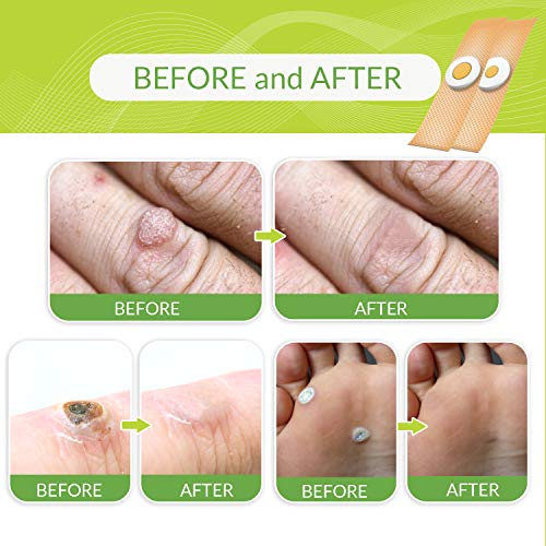 Wart Remover Pads, Remove Plantar and Common Warts Advanced Natural