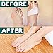 VILLINI Bunion Corrector Splint Big Toe - Gel Pads - Orthopedic Corrector Brace Pads & Metatarsal Pads - Elastic ‎Bunion Corrector for Women and Men - Non Surgical Hallux Valgus Correction Relief
