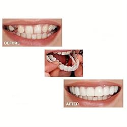 Cosmetic Snap On Teeth Veneers, Upper and Lower