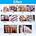 Toenail Fungus Treatment,Fungal Nail Gel,Fungus Stop,Nail Fungus Treatment Anti Fungal Nail Solution,Effective Against Nail Fungus