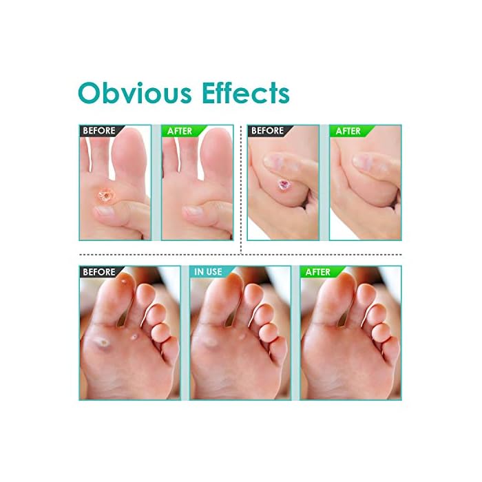 16 Pads Corn Wart Remover Pads, Plantar Wart Remover, Salicylic Acid