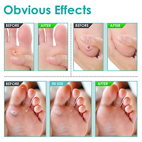 16 Pads Corn WartÂ RemoverÂ Pads, Plantar Wart Remover, Salicylic Acid Wart Removal Bandaids - Toe Corn and Callus Removal for Foot Caring