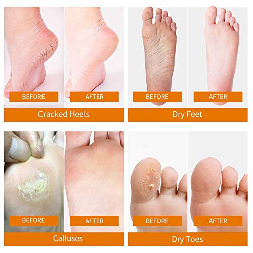 Mixbeauty Foot Peel Mask -2 Pack- Professional Exfoliating Foot Mask for Cracked Heels, Dead Skin & Calluses, Get Baby Soft Skin for Men&Women, Natural Ingredient & Zero Painess(Orange）