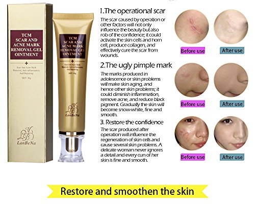 3 Removal+Operation+Stretch+Remover+Treatment
