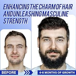 Minoxidil for Men Hair Regrowth